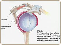 Acromial3