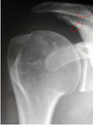 Tendinite Calcifiante De La Coiffe Des Rotateurs Institut Francais De Chirurgie De La Main